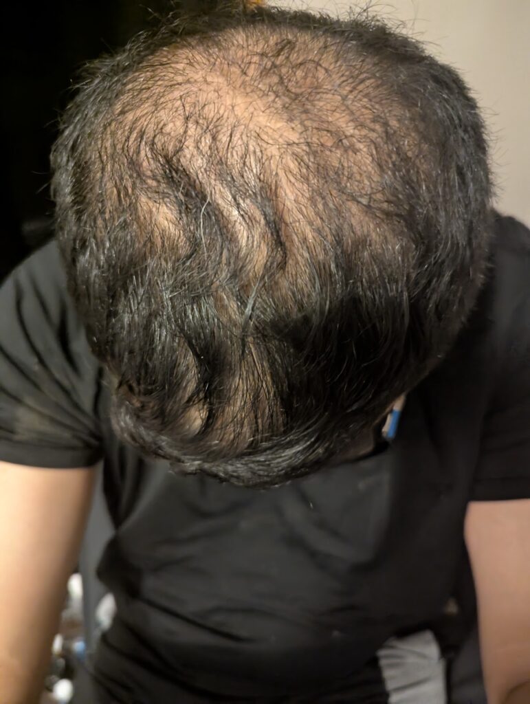 Hair Transplant Medical Centre Mississauga & Toronto | Hair Loss Treatment gallery photo
