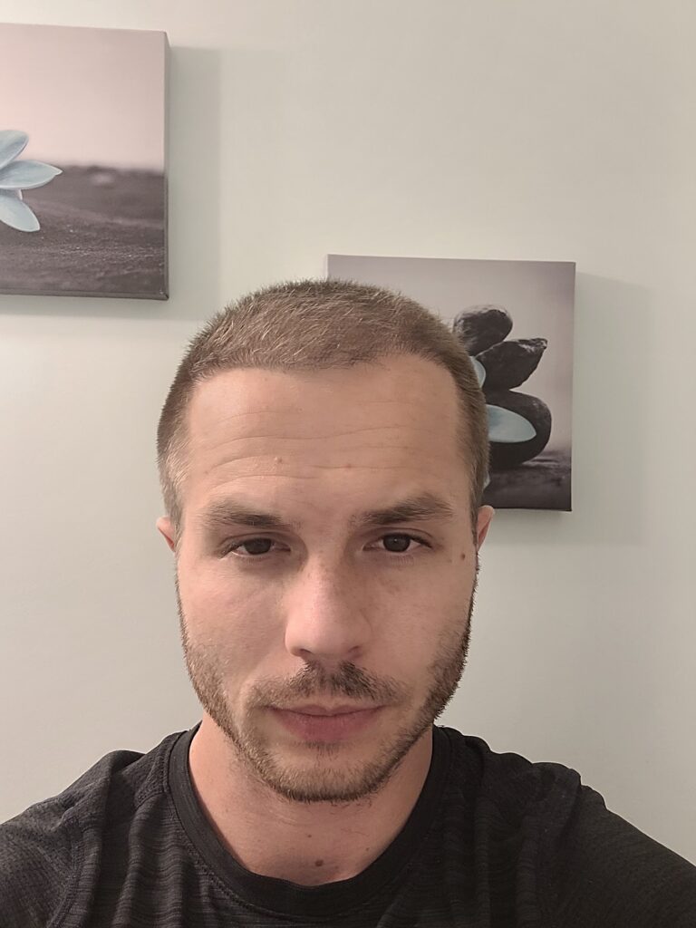 Hair Transplant Medical Centre Mississauga & Toronto | Hair Loss Treatment gallery photo