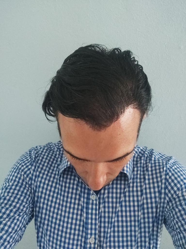 International Hair Transplant Clinic Tijuana gallery photo