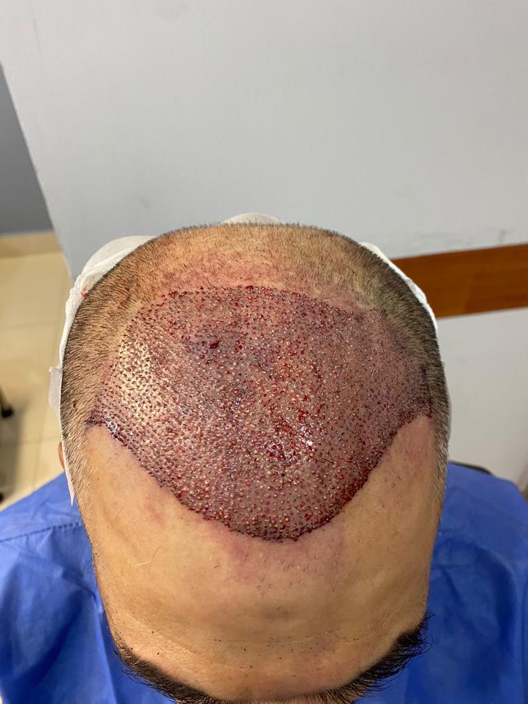 International Hair Transplant Clinic Tijuana gallery photo
