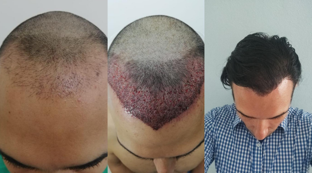 International Hair Transplant Clinic Tijuana gallery photo