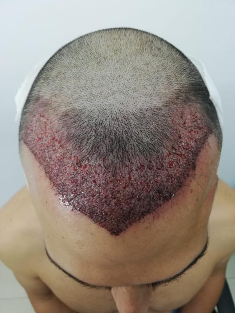 International Hair Transplant Clinic Tijuana gallery photo