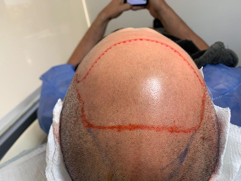 International Hair Transplant Clinic Tijuana gallery photo