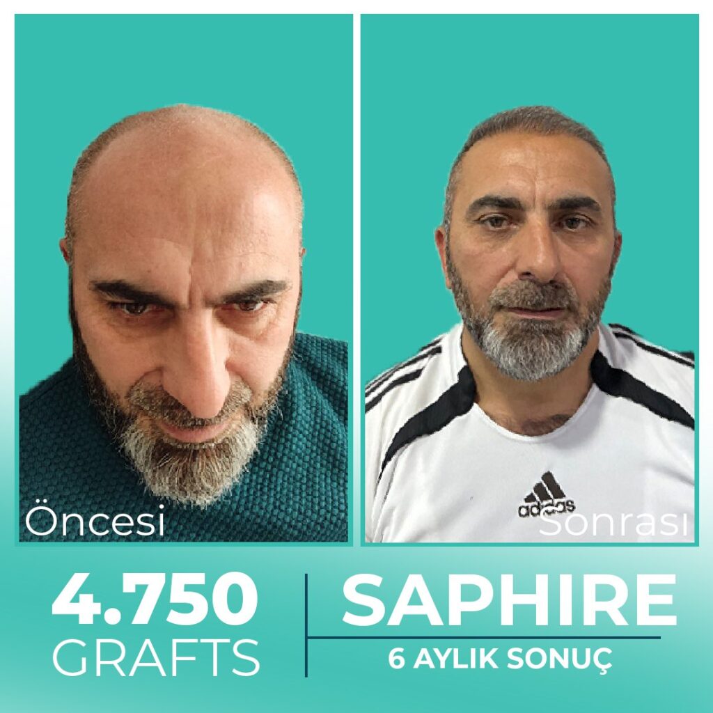 Odio Clinic – Cidde Hair Transplant Center gallery photo
