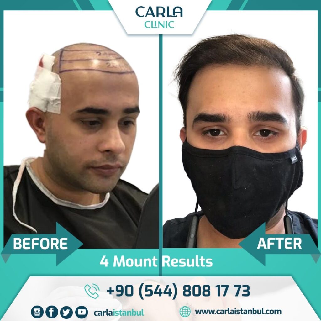 Odio Clinic – Cidde Hair Transplant Center gallery photo