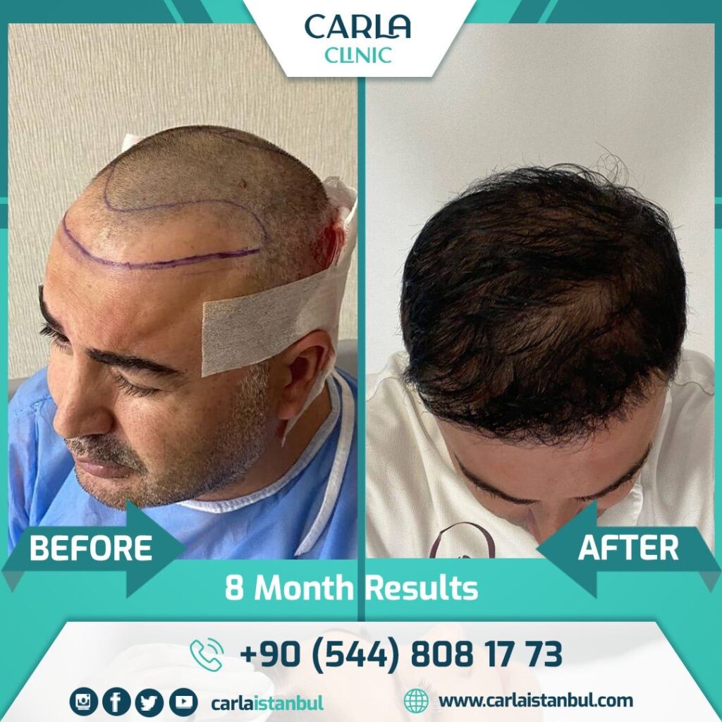 Odio Clinic – Cidde Hair Transplant Center gallery photo