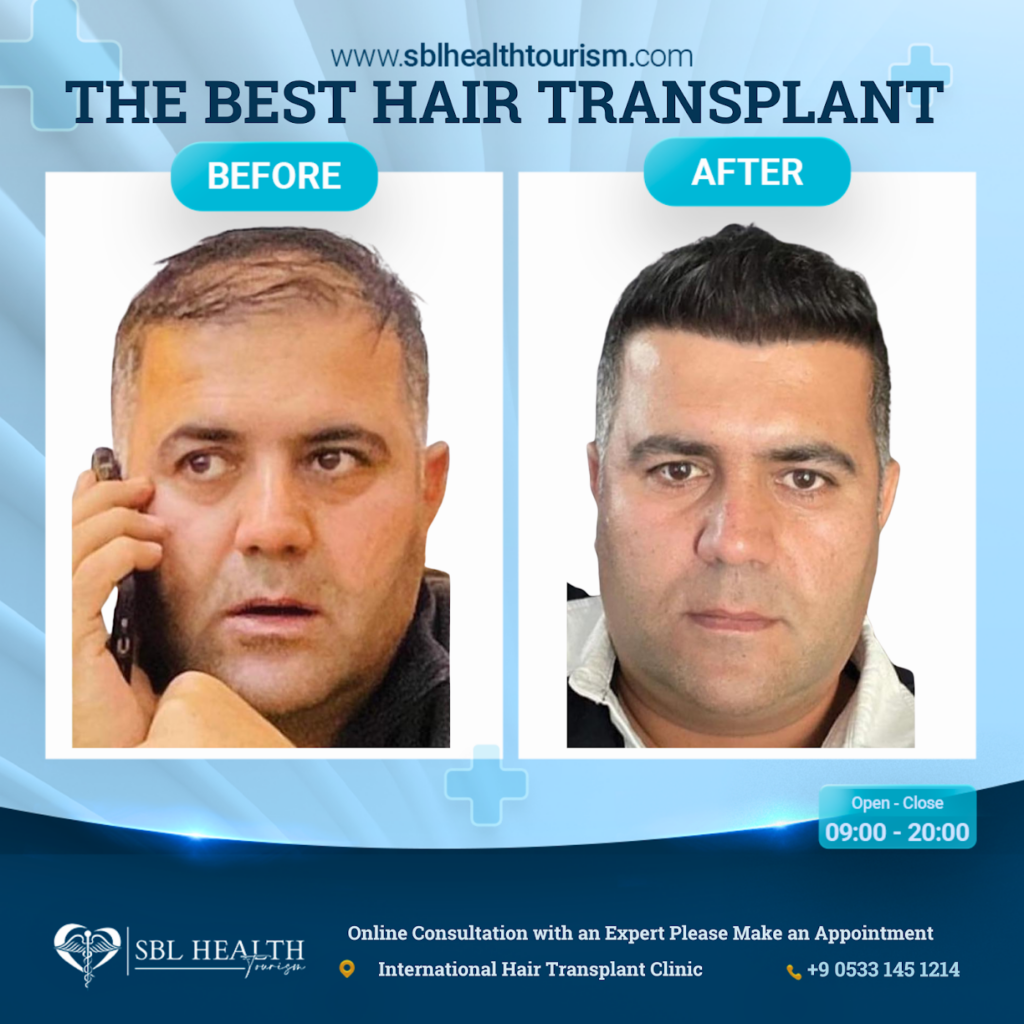 The Best Hair Transplant – FUE Maximum Graft in 1 Day Dubai Clinic / SBL Health gallery photo