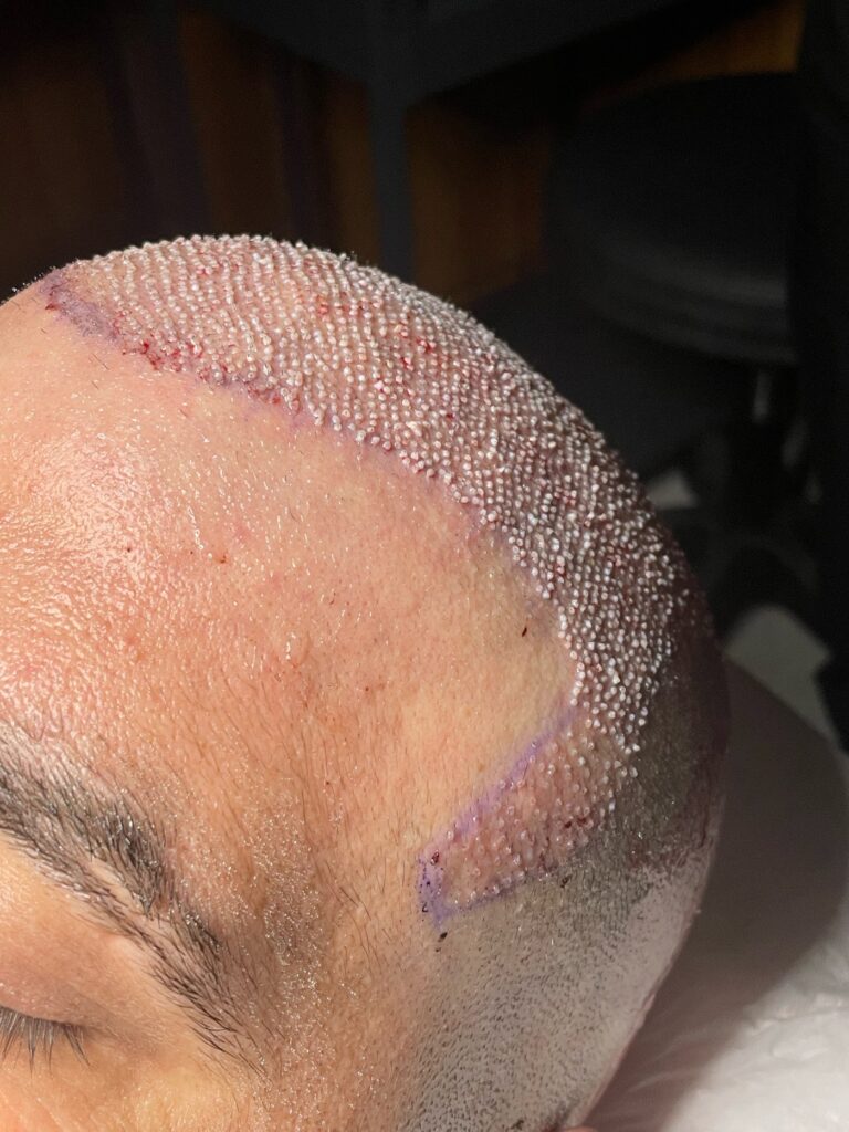 The Best Hair Transplant – FUE Maximum Graft in 1 Day Dubai Clinic / SBL Health gallery photo