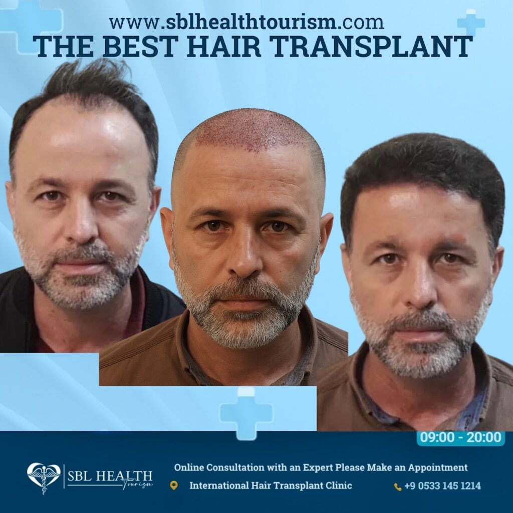The Best Hair Transplant – FUE Maximum Graft in 1 Day Dubai Clinic / SBL Health gallery photo