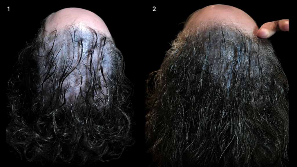 Progen Hair Loss Center Austin gallery photo