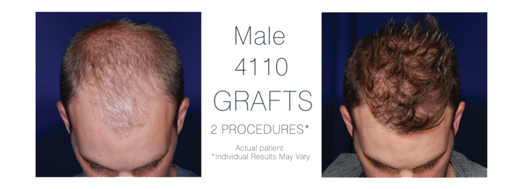 Ohio Hair Restoration gallery photo