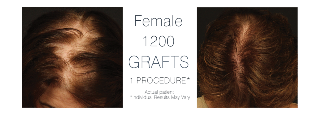 Ohio Hair Restoration gallery photo