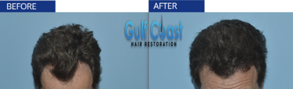 Gulf Coast Hair Restoration gallery photo