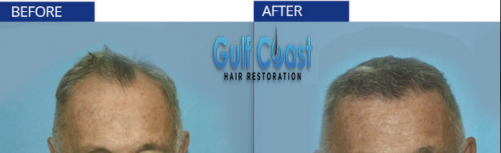 Gulf Coast Hair Restoration gallery photo