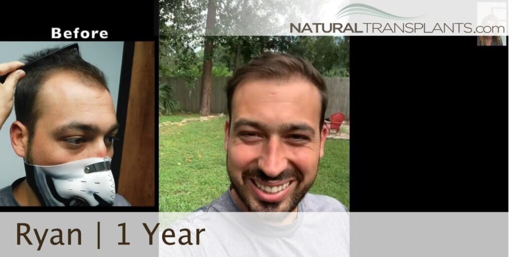 Natural Transplants, Hair Restoration Clinic gallery photo