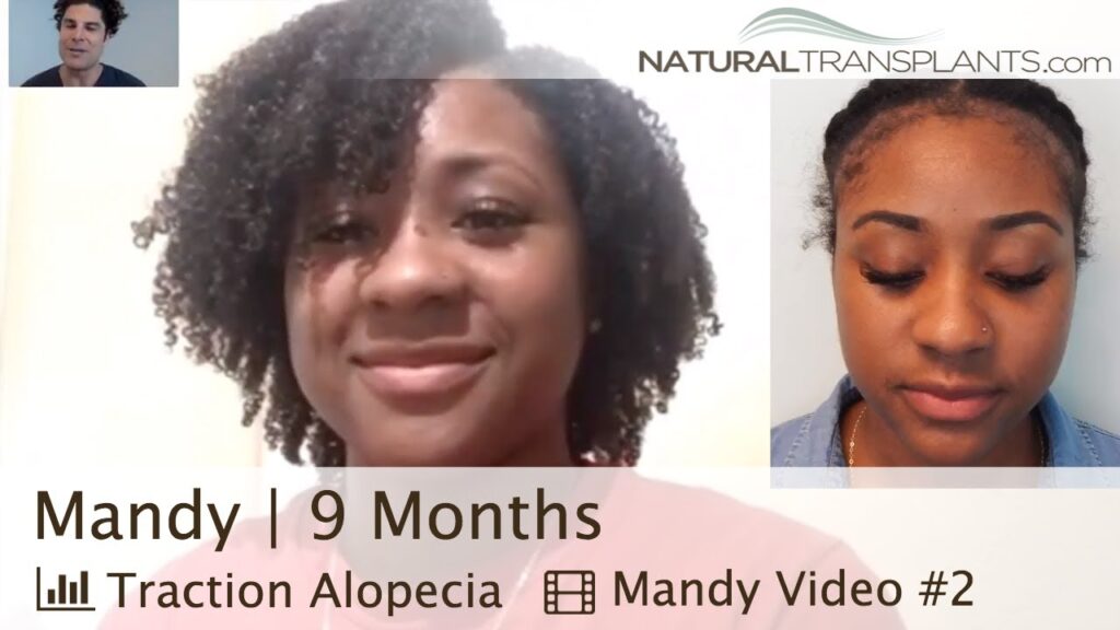Natural Transplants, Hair Restoration Clinic gallery photo