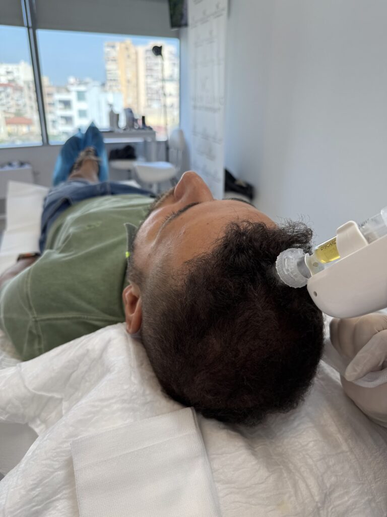 Major Clinic Italia – Albania – Hair Transplant gallery photo