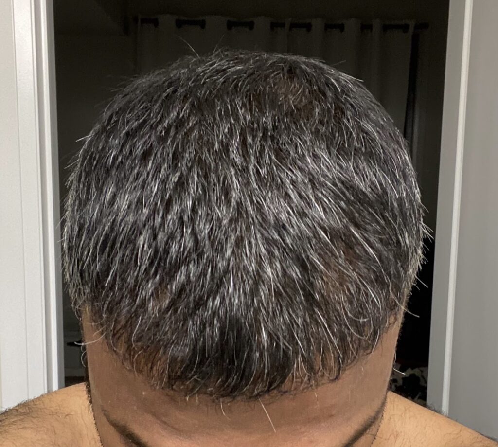 Toronto Hair Transplant Surgeons gallery photo