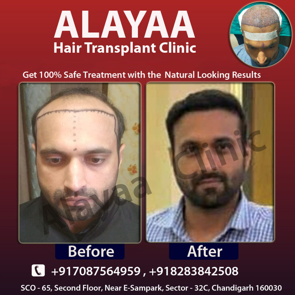 Alayaa Hair Transplant Specialist gallery photo