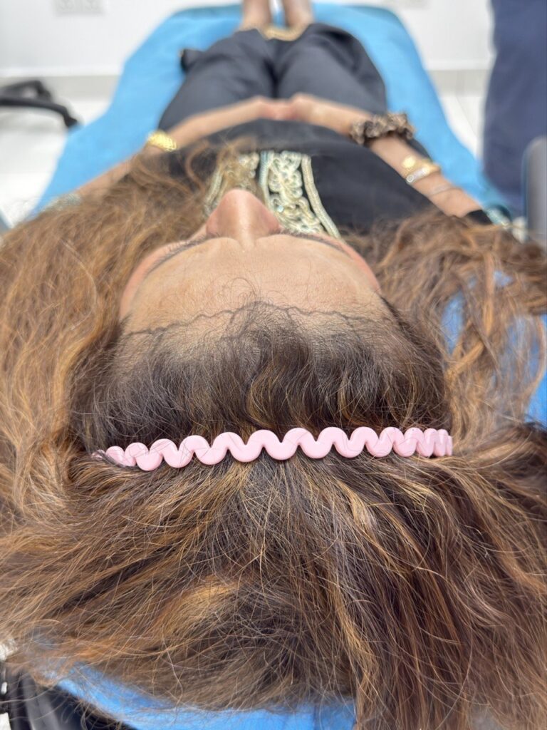 iGraft Long Hair FUE gallery photo