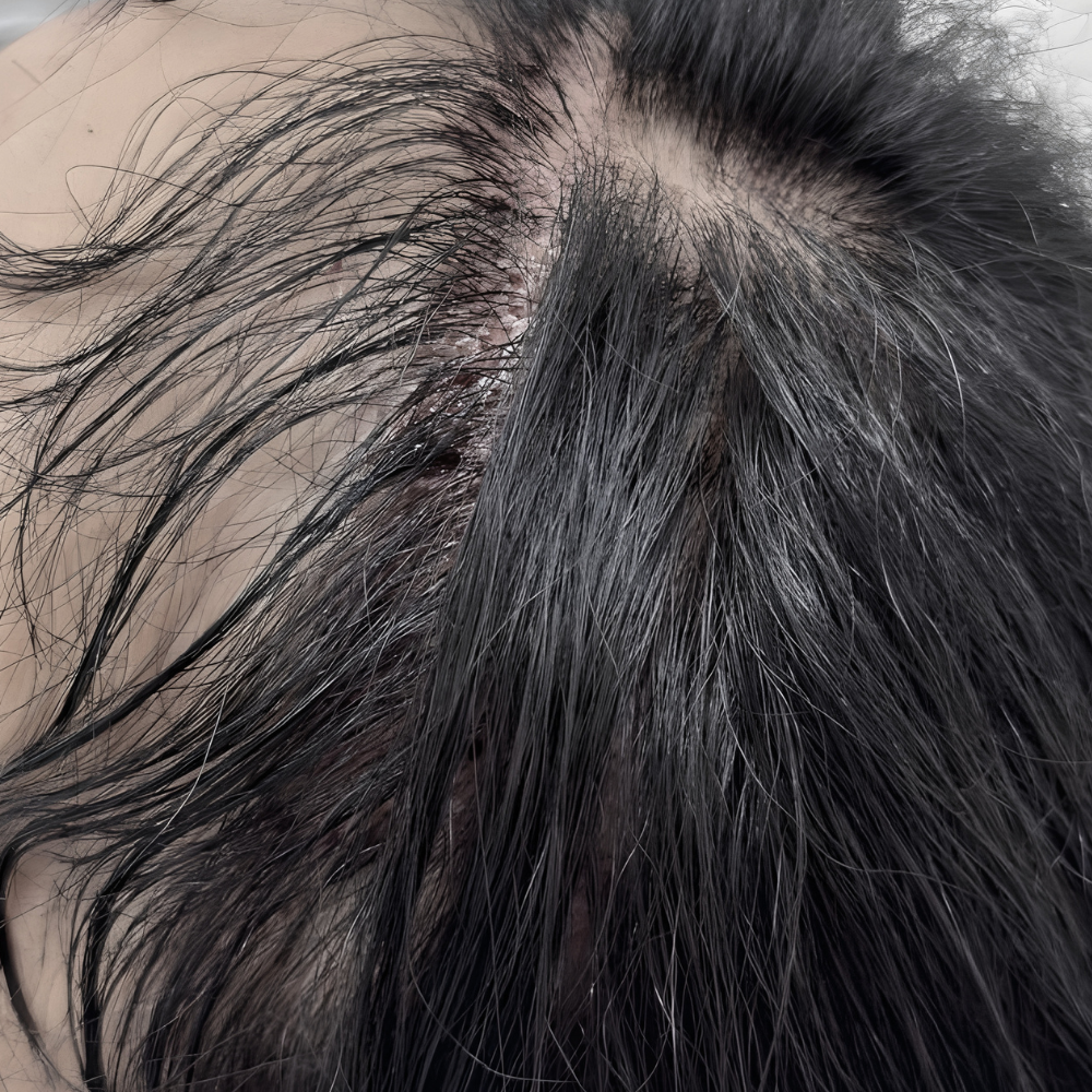iGraft Long Hair FUE gallery photo