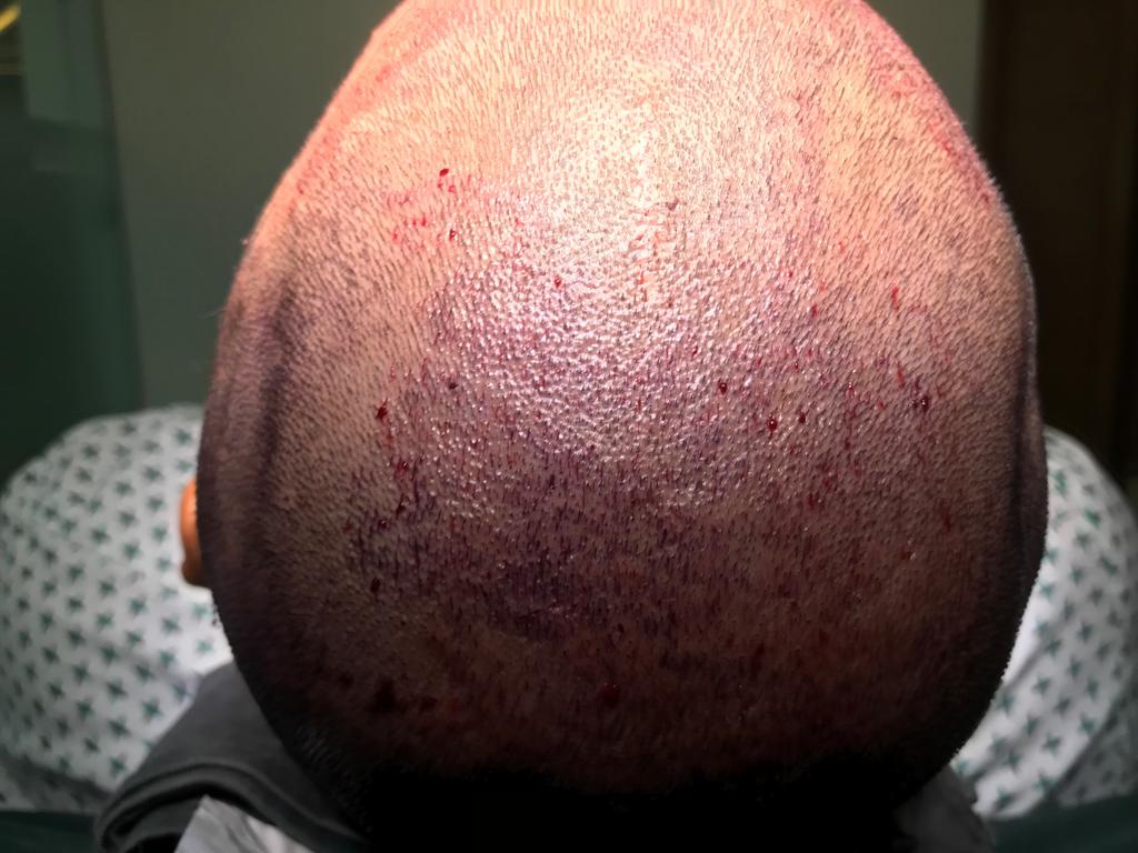 Glamorous Hair Transplant in Islamabad | Hair Surgeon’s – FUE Hair Transplant Islamabad, FUT Transplant, BioFibre, PRF gallery photo