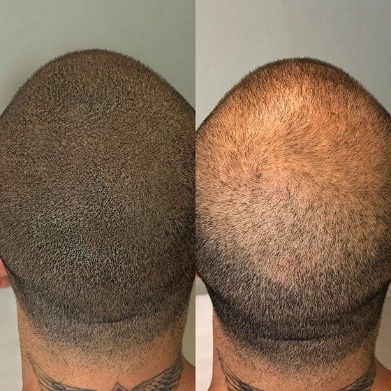 Glamorous Hair Transplant in Islamabad | Hair Surgeon’s – FUE Hair Transplant Islamabad, FUT Transplant, BioFibre, PRF gallery photo