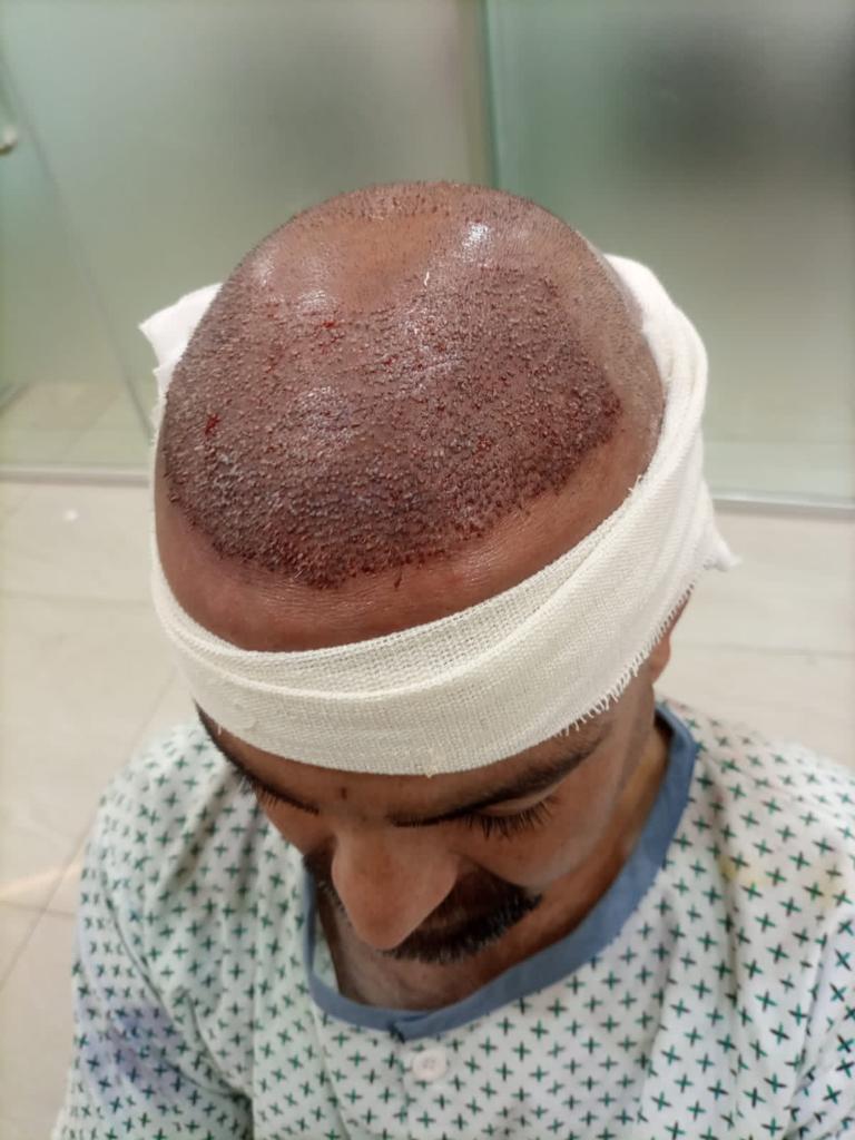 Glamorous Hair Transplant in Islamabad | Hair Surgeon’s – FUE Hair Transplant Islamabad, FUT Transplant, BioFibre, PRF gallery photo