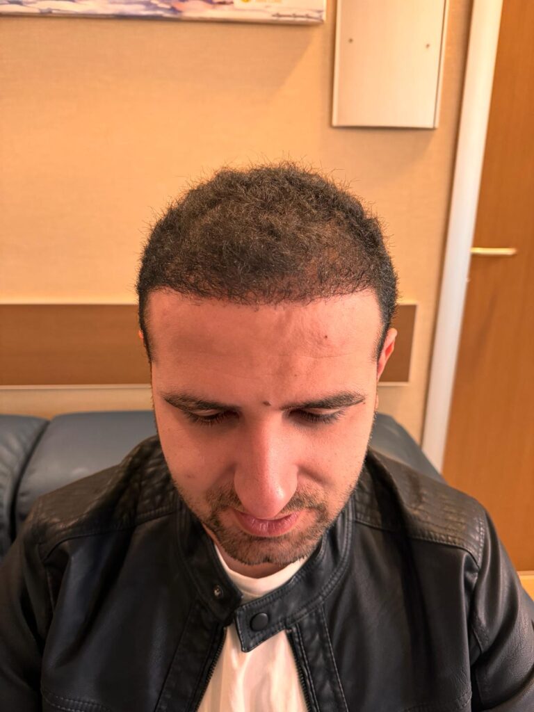 Bilyana Hair Transplant gallery photo