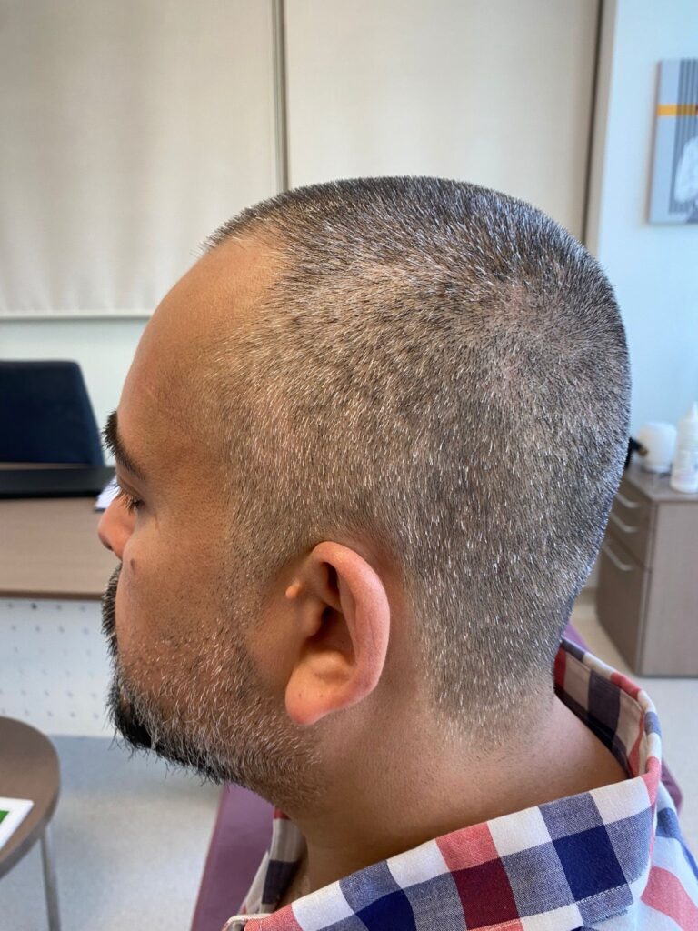 Bilyana Hair Transplant gallery photo