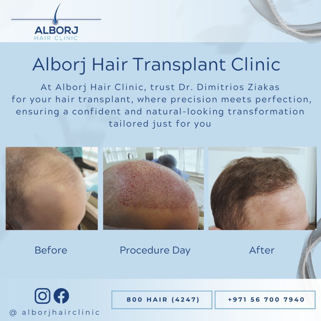 ALBORJ HAIR CLINIC – Hair Transplant Clinic gallery photo