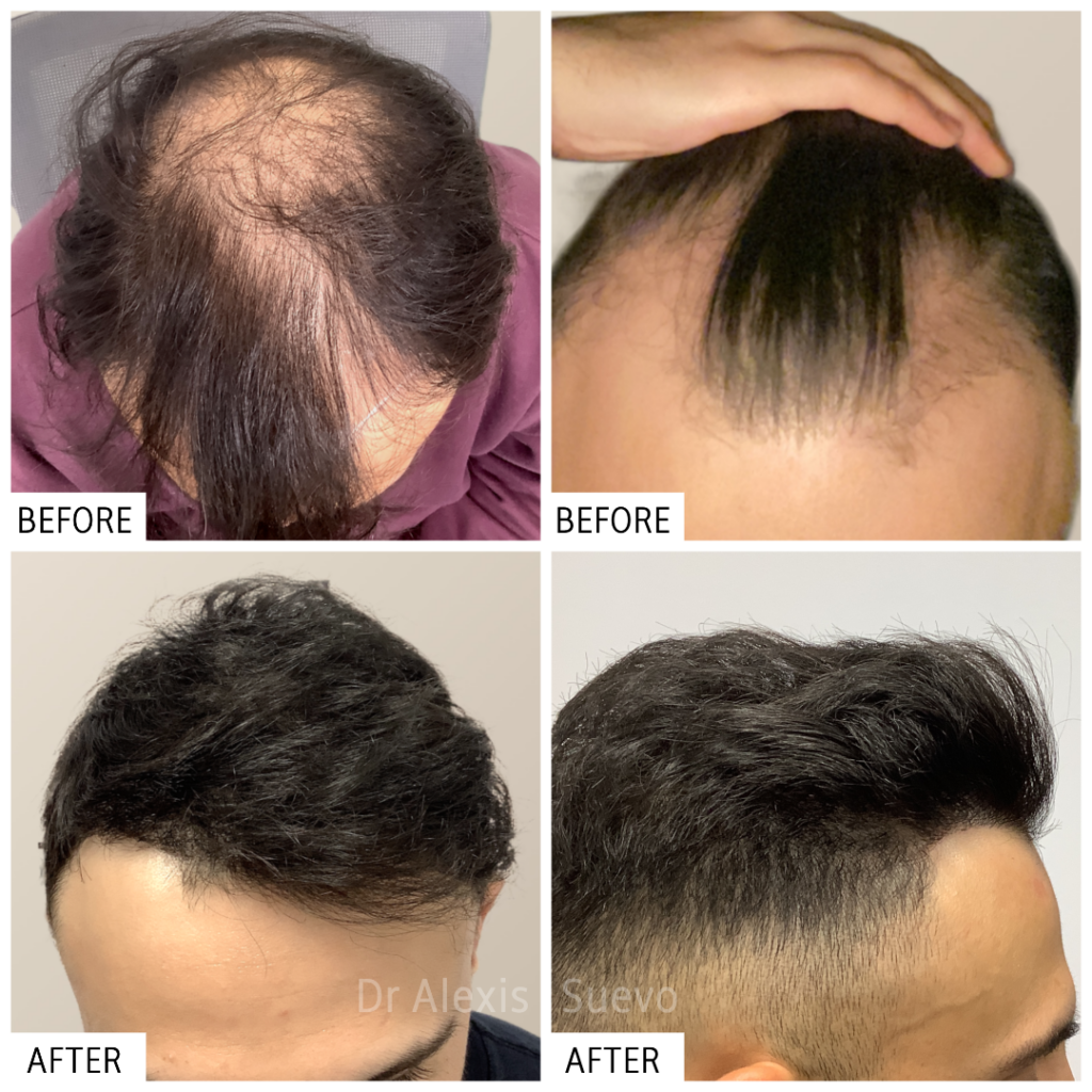 ANAGEN Clinic | Hair Transplant Doctor Melbourne gallery photo