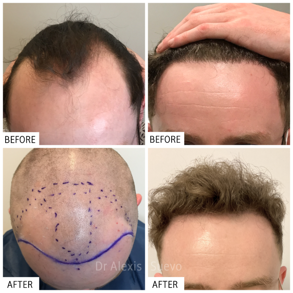 ANAGEN Clinic | Hair Transplant Doctor Melbourne gallery photo