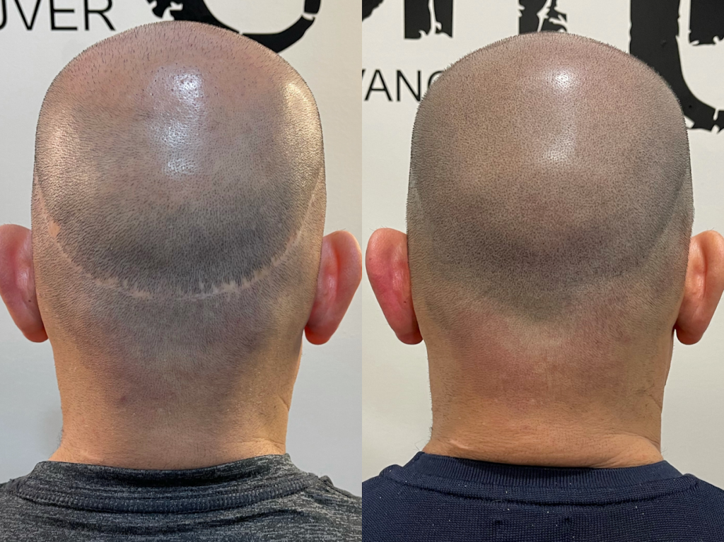 SMP Vancouver – Hair Tattoo Inc. | SMP By Luis Enrique gallery photo