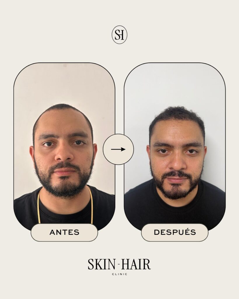 Skin Hair Clinic- Hair Restoration Clinic-Hair Transplant Medellin-Trasplante Capilar Medellin-Beard-PRP Hair-FUE-DHI-Botox gallery photo