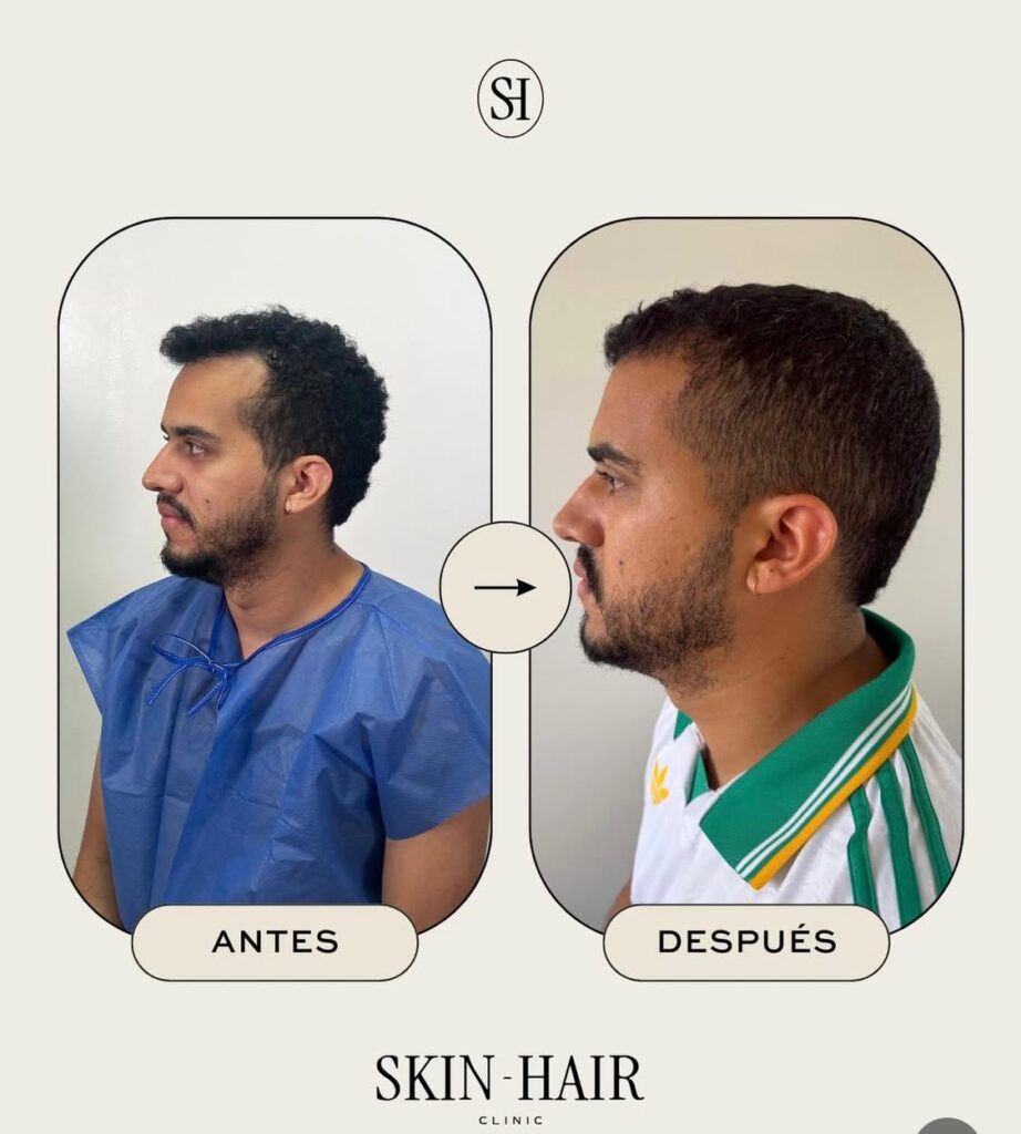Skin Hair Clinic- Hair Restoration Clinic-Hair Transplant Medellin-Trasplante Capilar Medellin-Beard-PRP Hair-FUE-DHI-Botox gallery photo