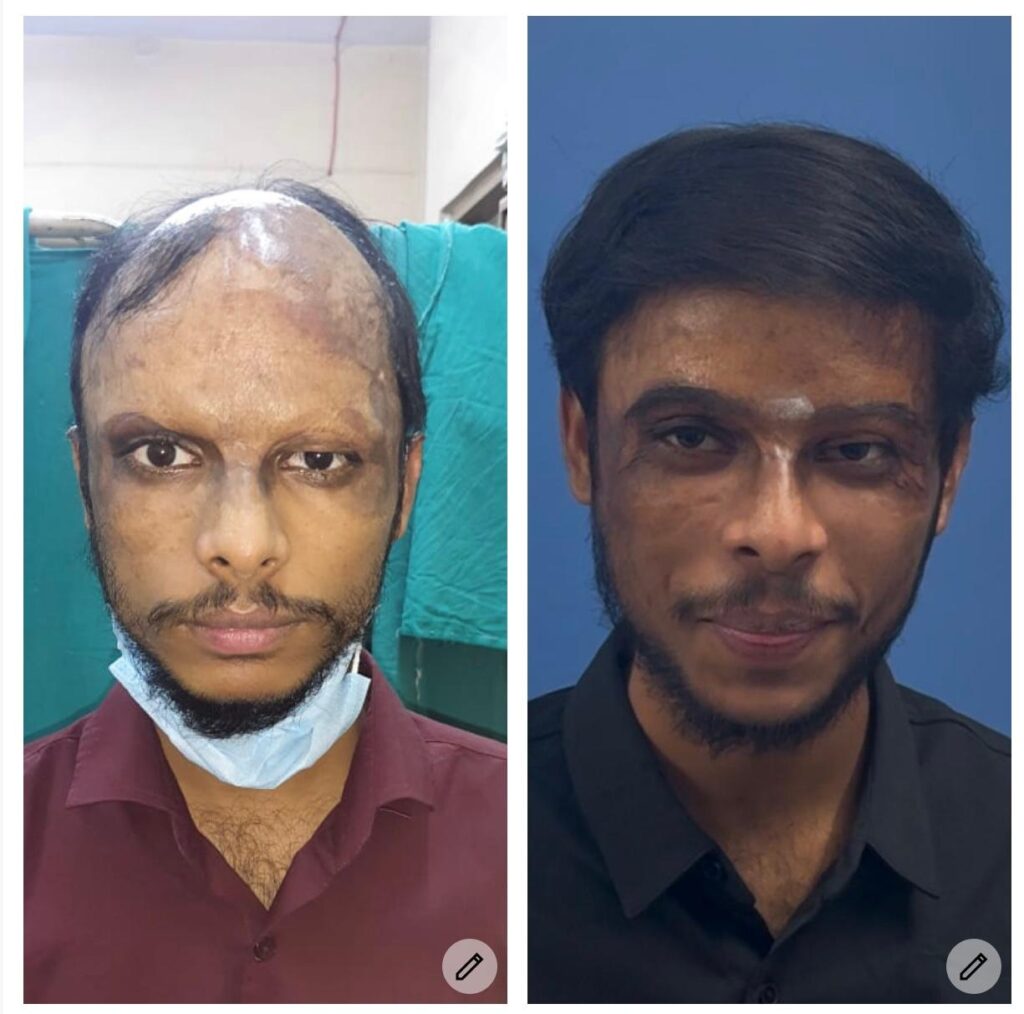 Hair Sure – Hair Transplant Centre gallery photo