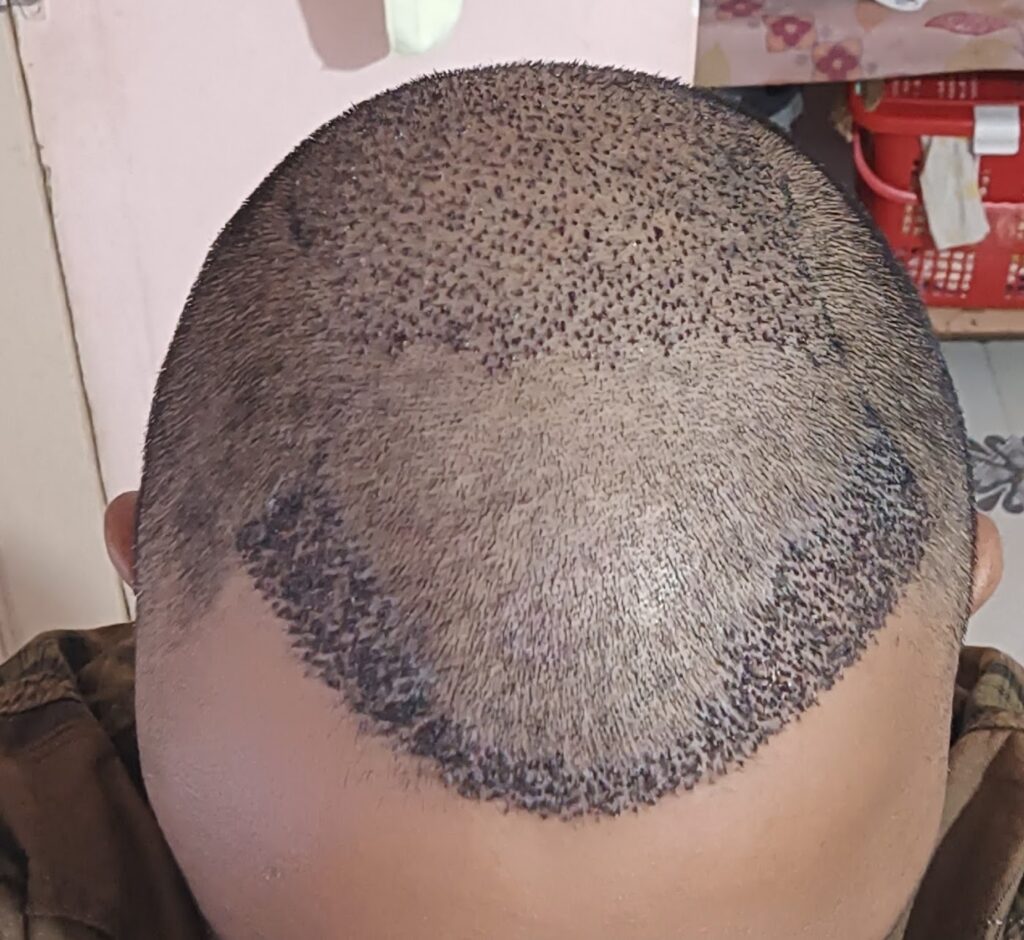 Anagen Hair Transplant Clinic : Natural Hairline | Baldness Treatment Best Hair Transplant Clinic in Mumbai gallery photo