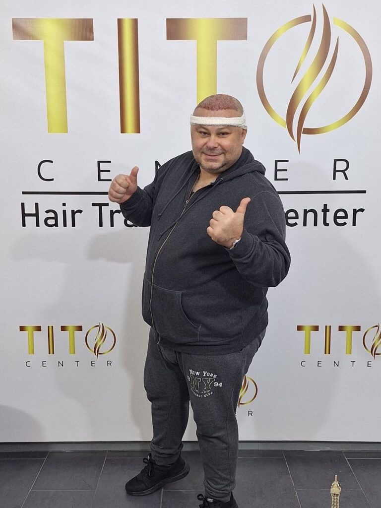 Hair transplant tito center gallery photo