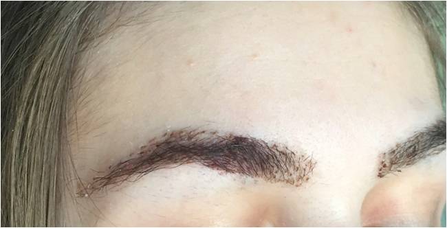 Transplant de păr – Hair transplant Bucuresti gallery photo