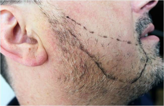 Transplant de păr – Hair transplant Bucuresti gallery photo
