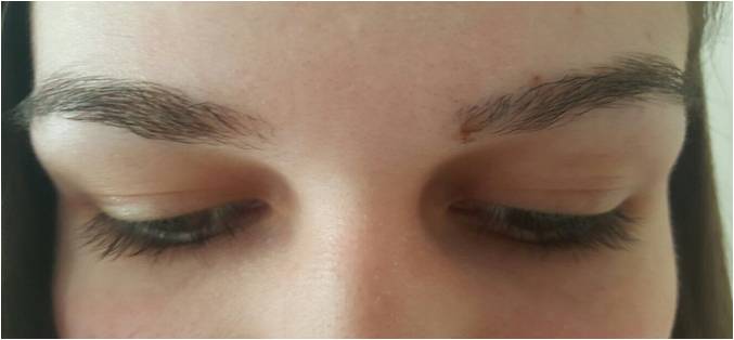 Transplant de păr – Hair transplant Bucuresti gallery photo