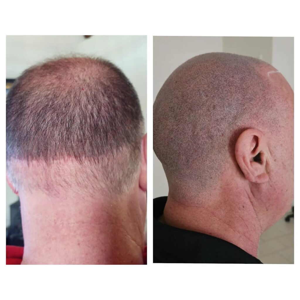 Hilton Hair SMP Clinic gallery photo