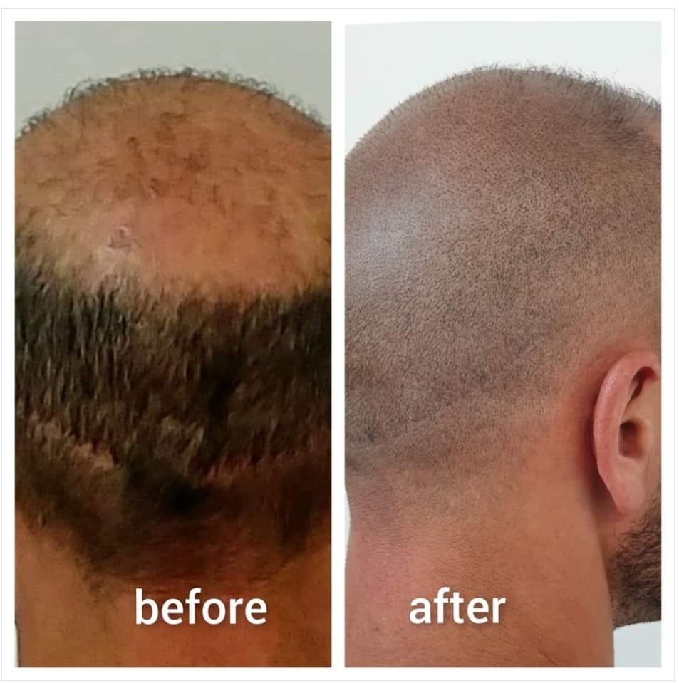 Hilton Hair SMP Clinic gallery photo