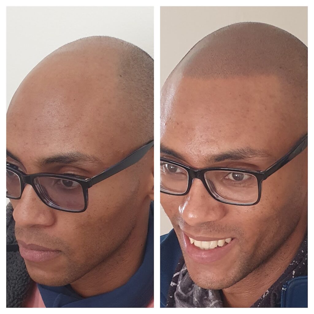 Hilton Hair SMP Clinic gallery photo
