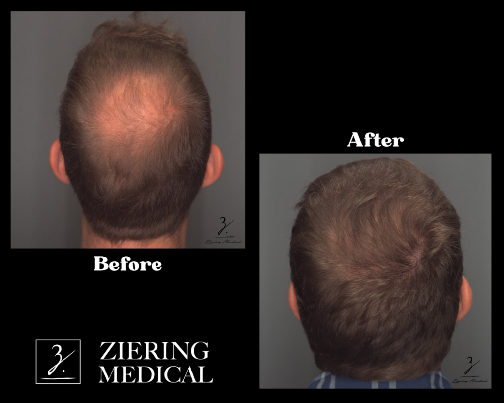 Ziering Medical Hair Restoration Connecticut gallery photo