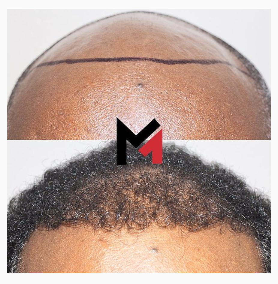Maxim Hair Restoration & Transplants – New Jersey gallery photo
