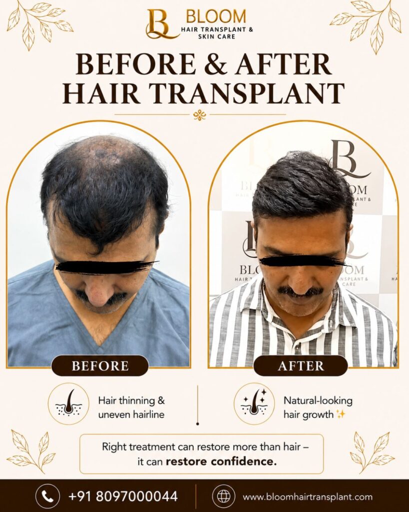 Bloom Hair Transplant Clinic | Affordable Hair Transplant in Mumbai | Celebrity Hair Restoration & Regrowth Treatments gallery photo