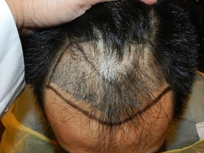 ✅ Dr. VJs Cosmetic Surgery Hair Transplant – Best Liposuction & Gynecomastia Surgery in Vizag | Hair Clinic in Vizag gallery photo