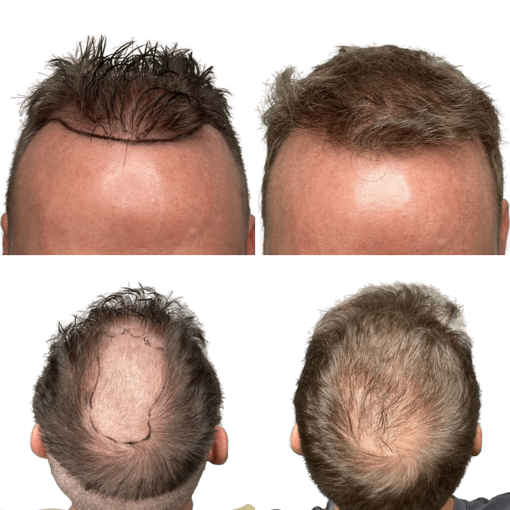 Maxim Hair Restoration & Transplants – Albany gallery photo